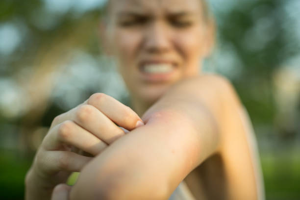 8 лесни домашни средства за лечение на ухапвания от комари